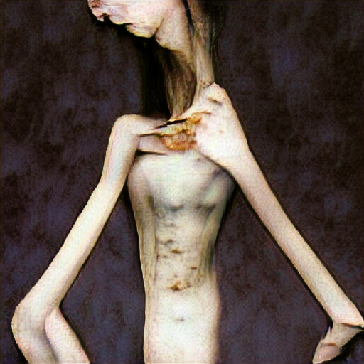 anorexia nervosa